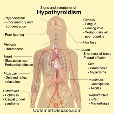 hypothyroidism signs